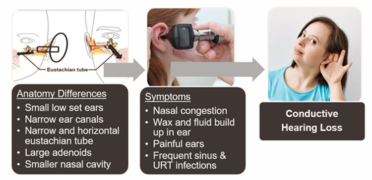 diagram illustrating conductive hearing loss in people with Down syndrome